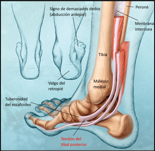 Tendinitis posterior