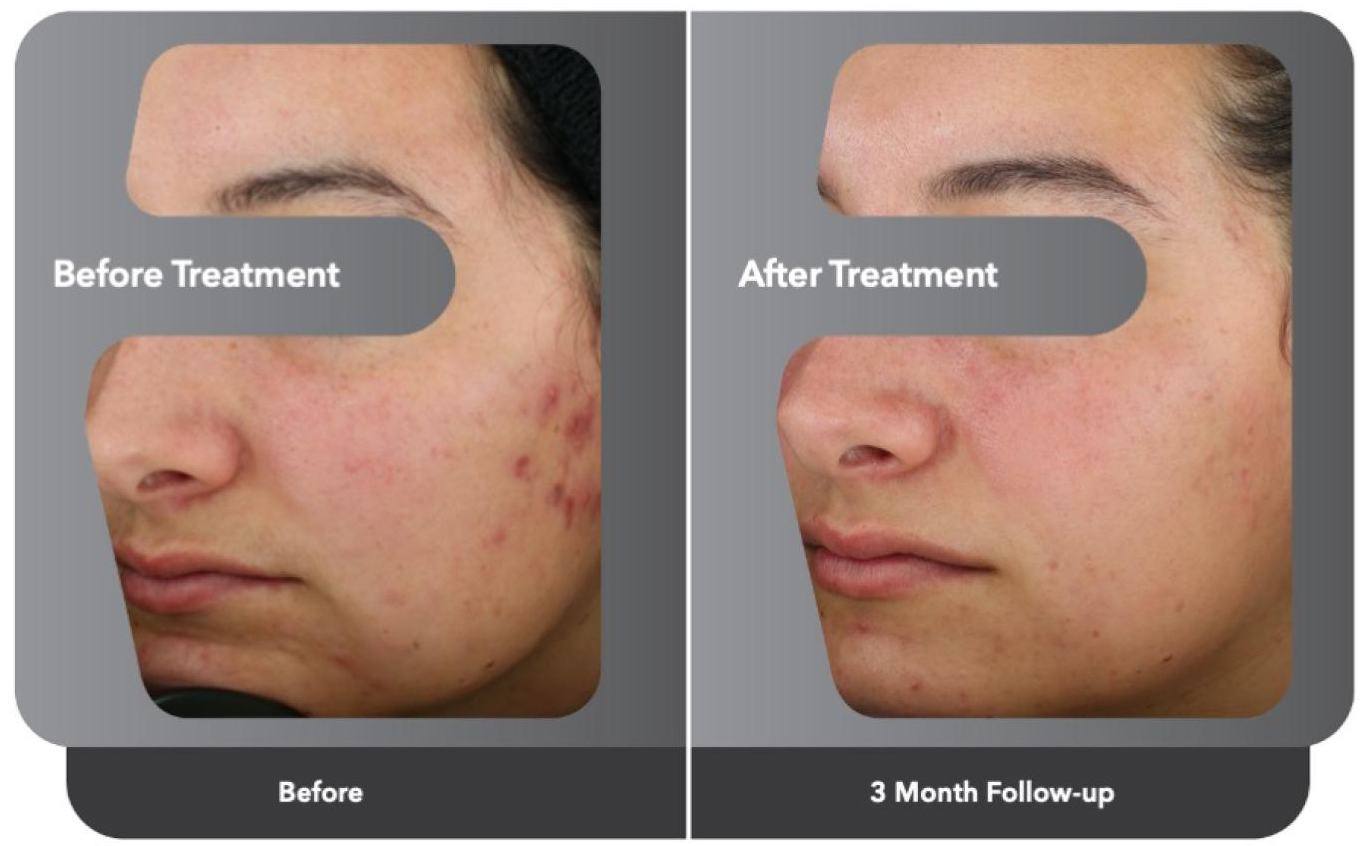 Accure Acne Laser Connecticut Skin Institute