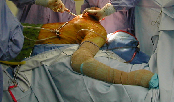 Thoracotomy for Exposure of the Spine