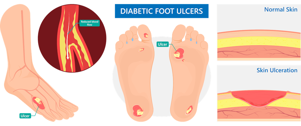 Diabetes Amputation Prevention | Ctvs Central Texas
