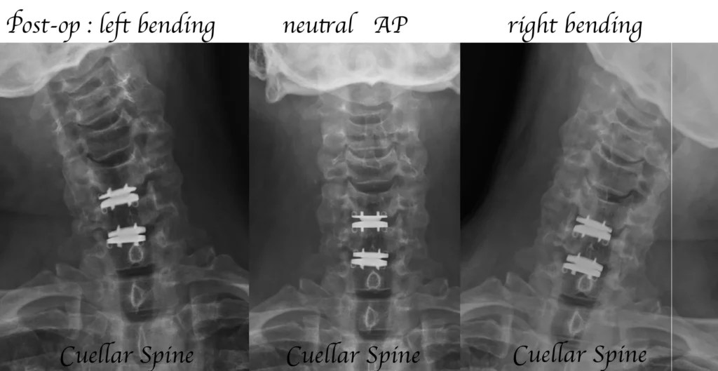 Two Level Cervical Disc Replacement Cuellar Spine