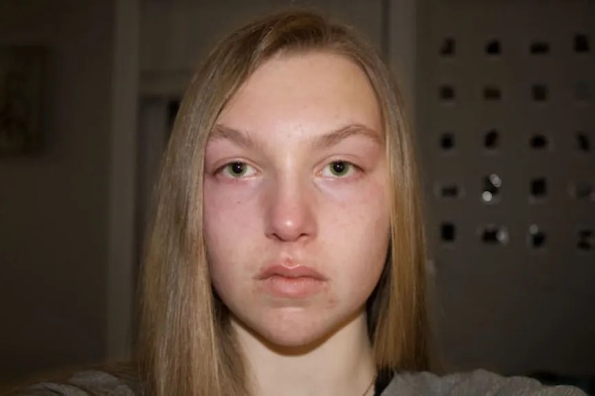 How Does Your Mental Health Contribute to Skin Problems? CupertinoTimes