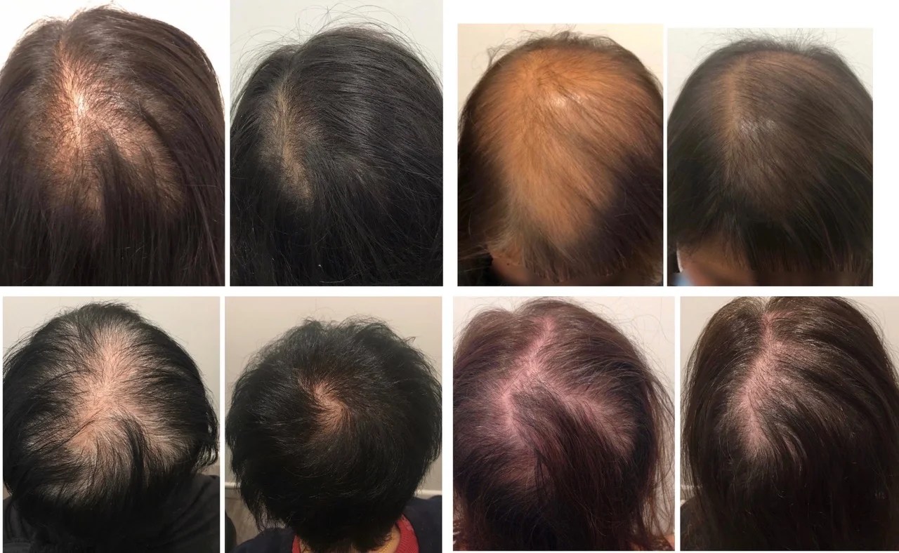 PRF / PRP Treatments for COVID Hair Loss