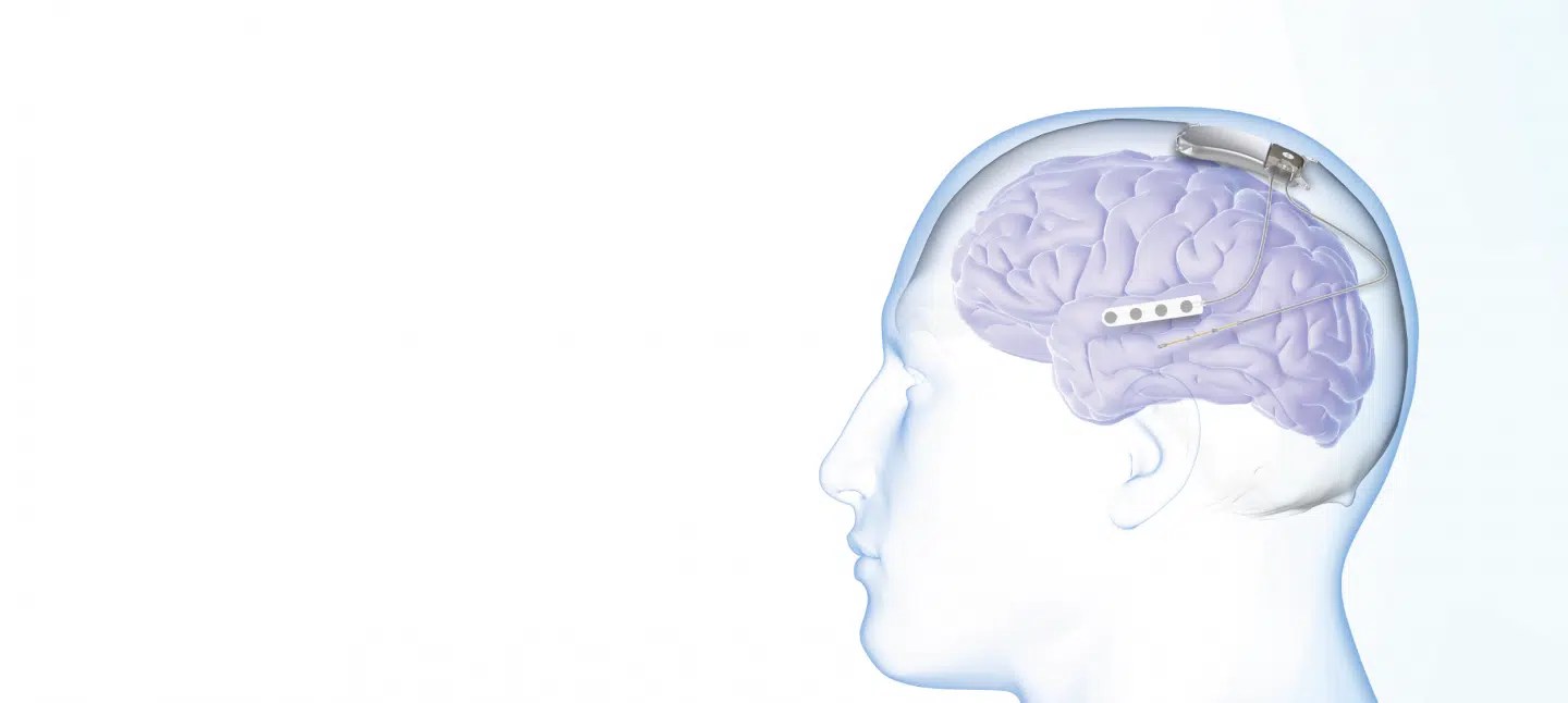 FDA Approves MRI Labeling for Neurostimulation System Designed to Prevent Seizures CURE Epilepsy