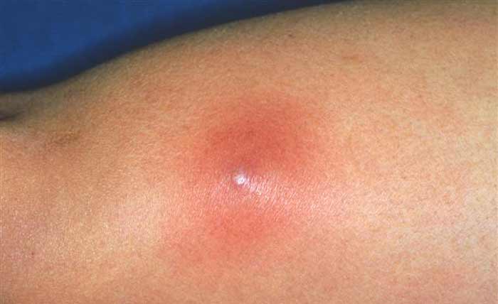 Ingrown Hair Boil Removal, Treatment & Pictures CureHows