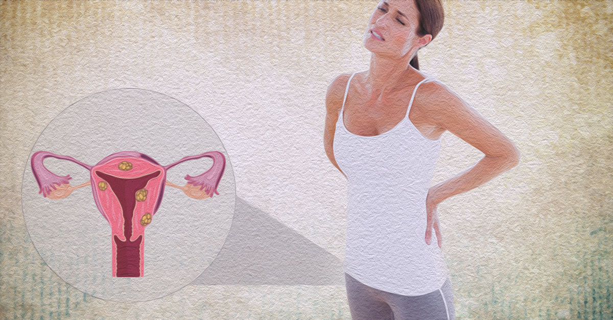 7 Tips For Treating Fibroids The Natural Way