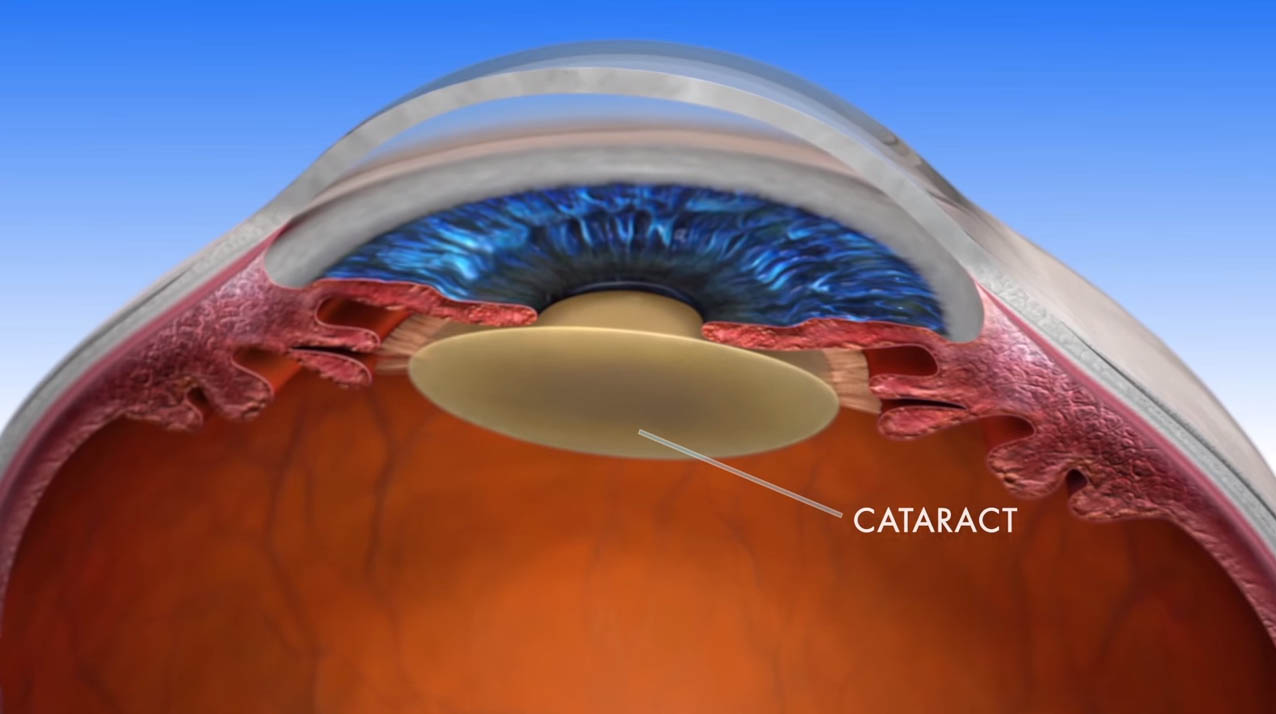 CATARACT Cure Sight Laser Center