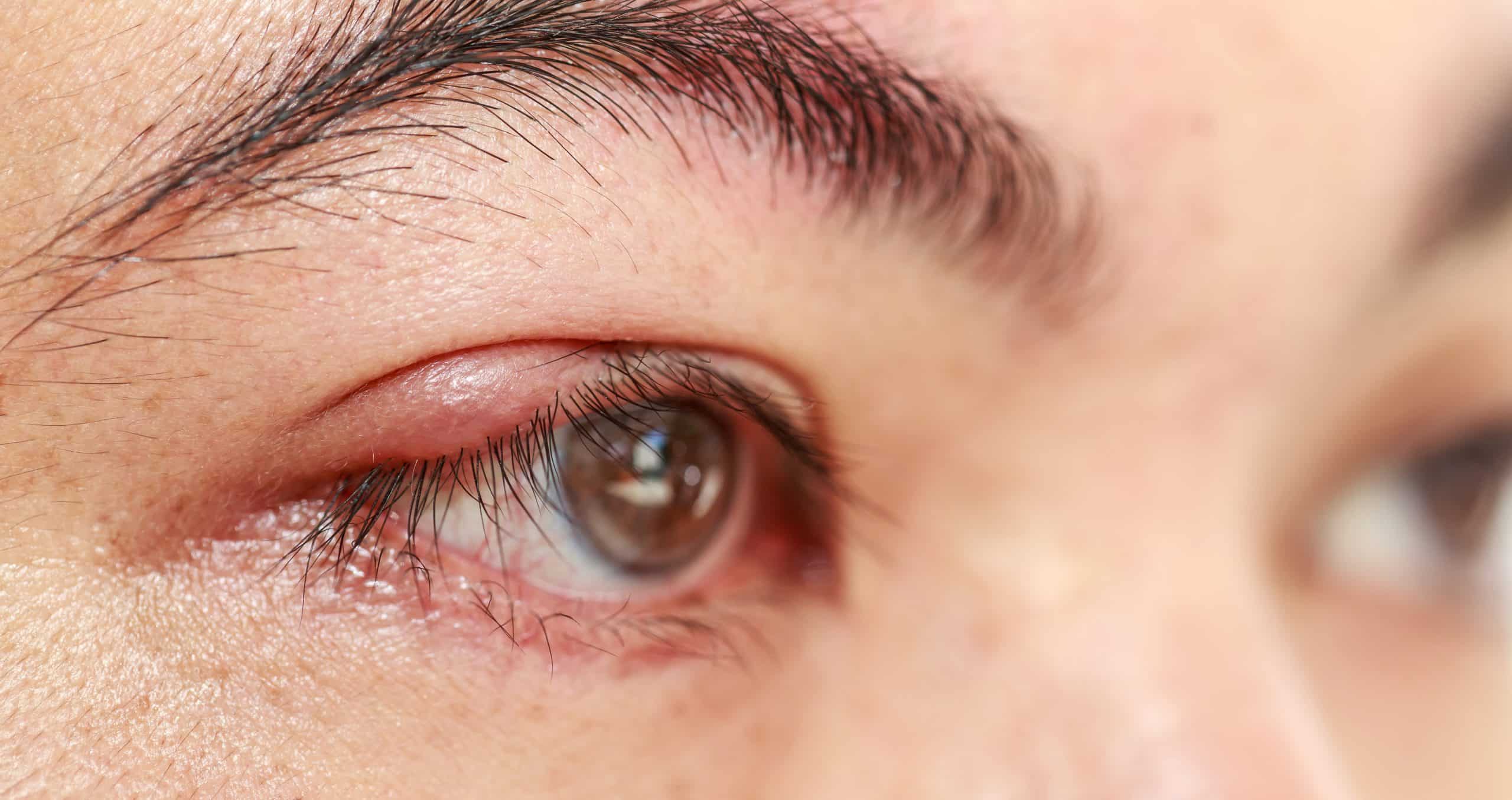 Eye Stye What is it? Causes and Treatment