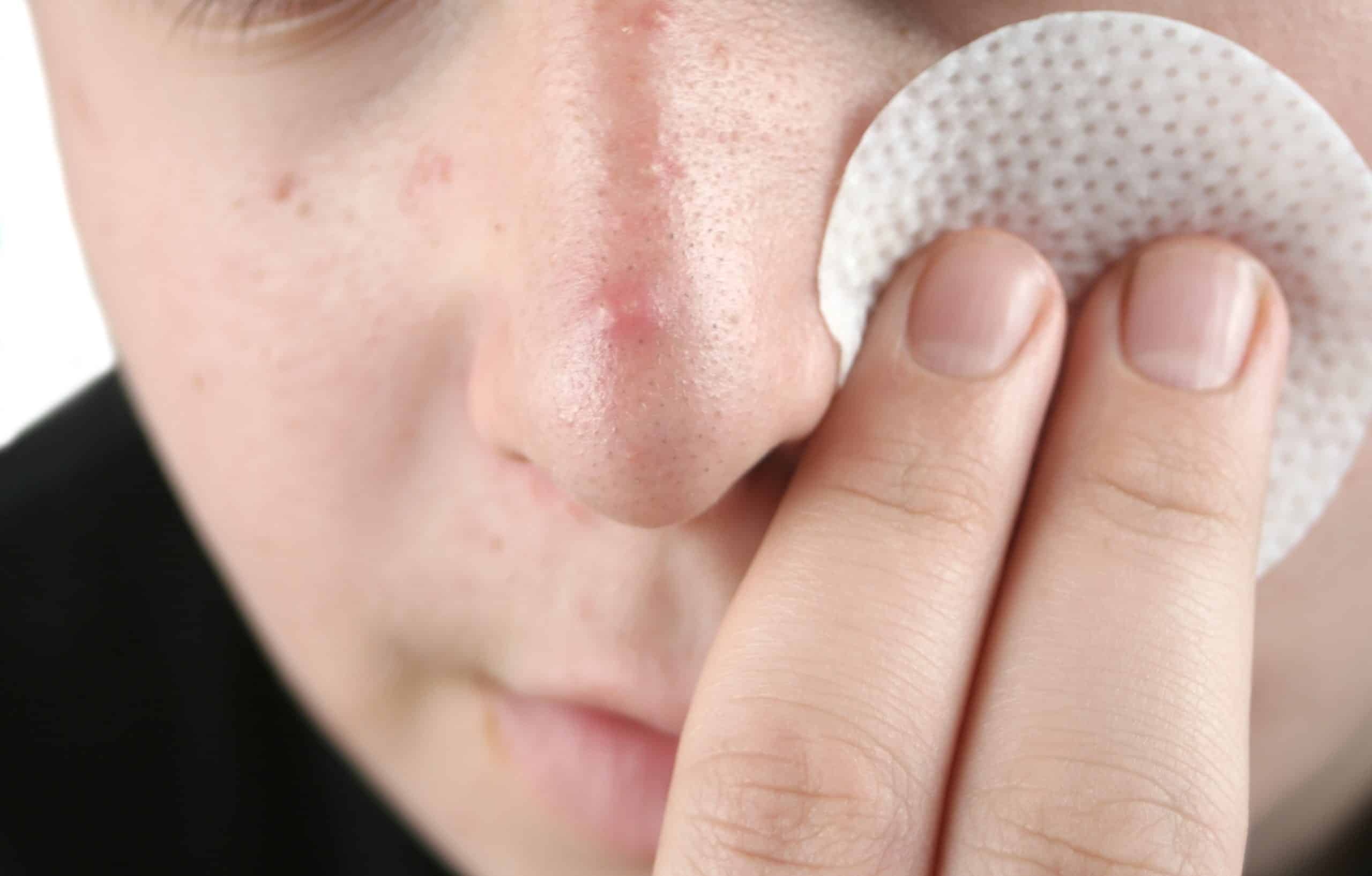 How To Prevent Pimples On Nose, According To Dermatologists!