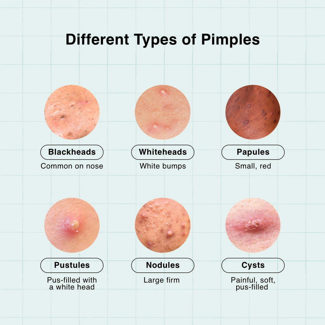 Pimples on forehead What are the Causes & Treatments?(03)