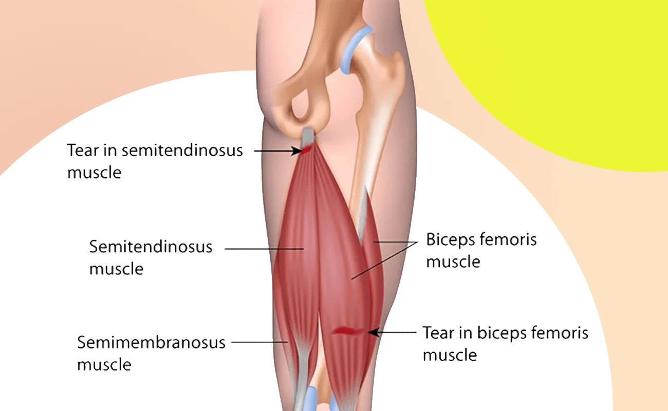 Hamstring strain » Curezone Physiotherapy