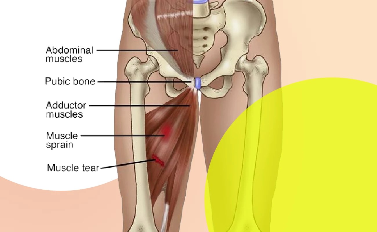 Groin Strain » Curezone Physiotherapy