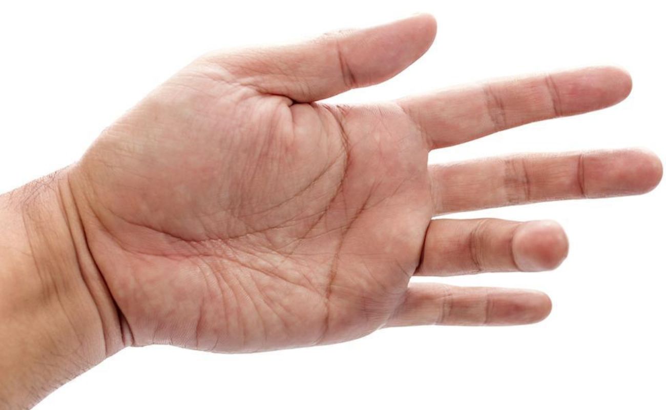 Trigger finger physiotherapy treatment Mississauga » Curezone Physiotherapy