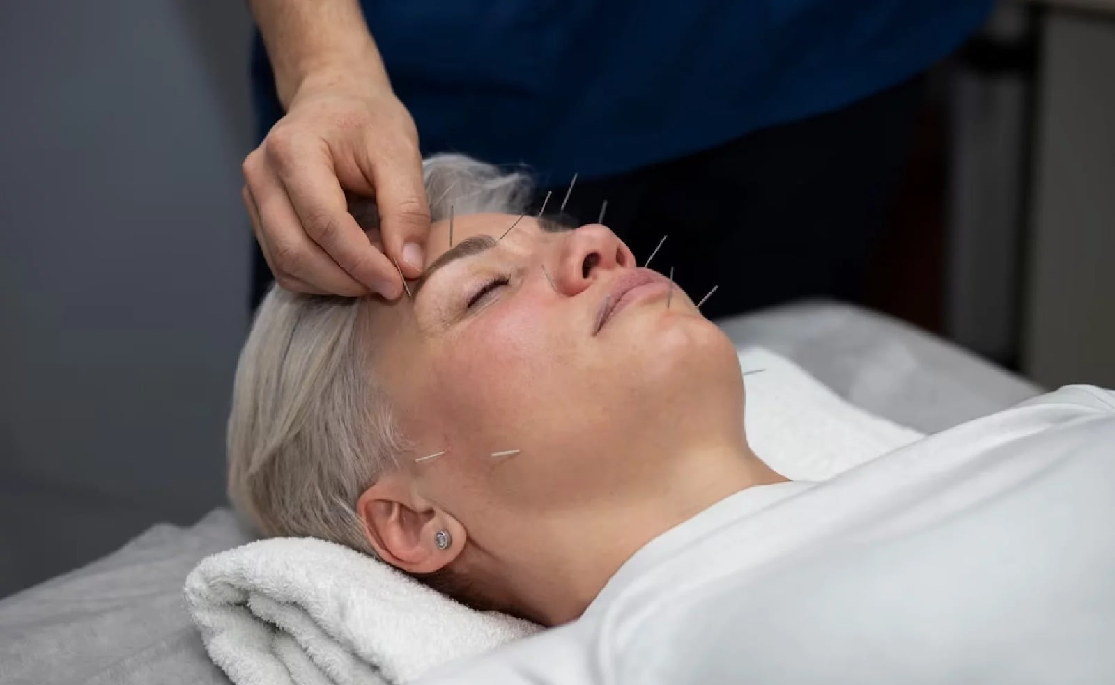 How does Acupuncture work in Physiotherapy? » Curezone Physiotherapy