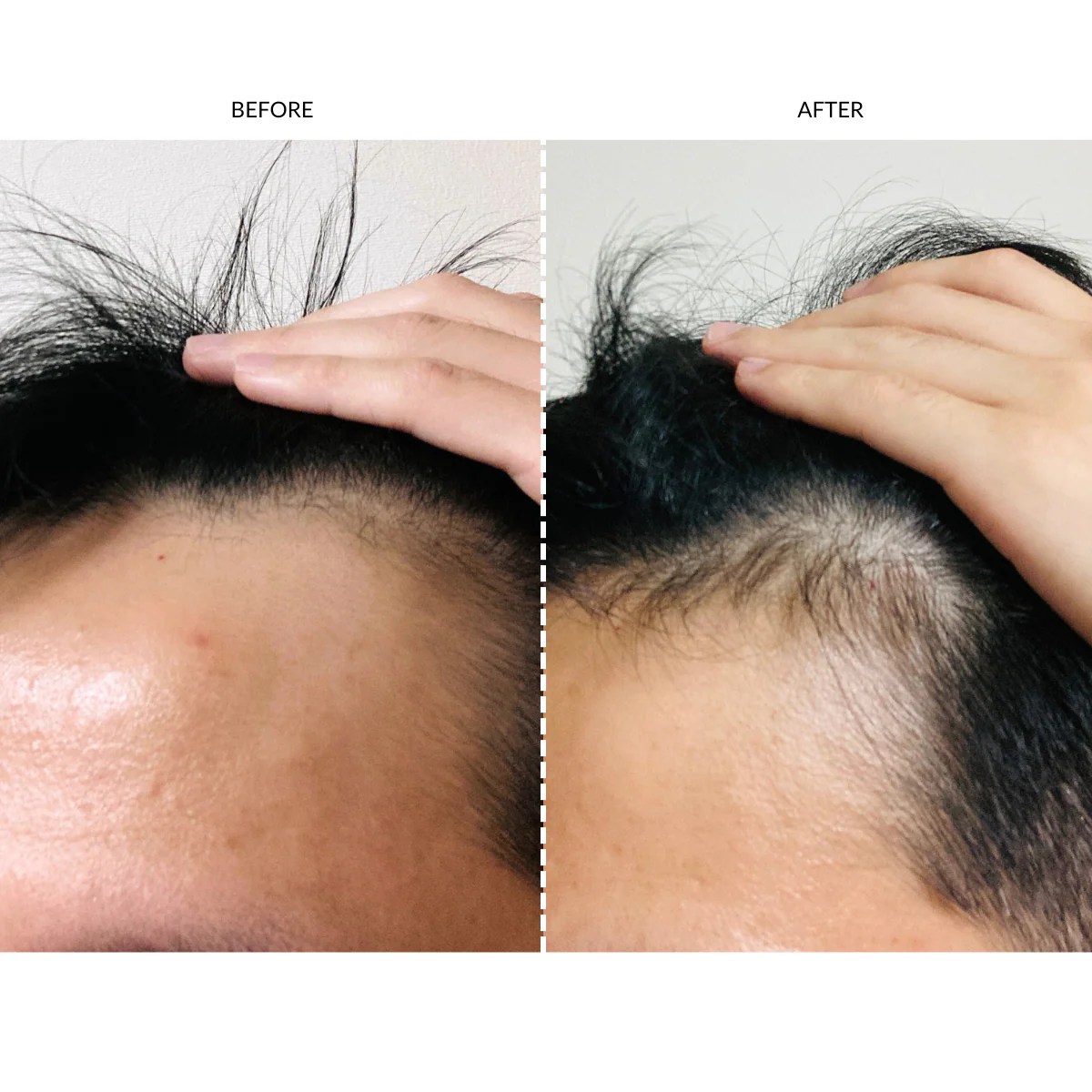 Does Red Light Therapy Help Hair Growth Before And After Shelly Lighting