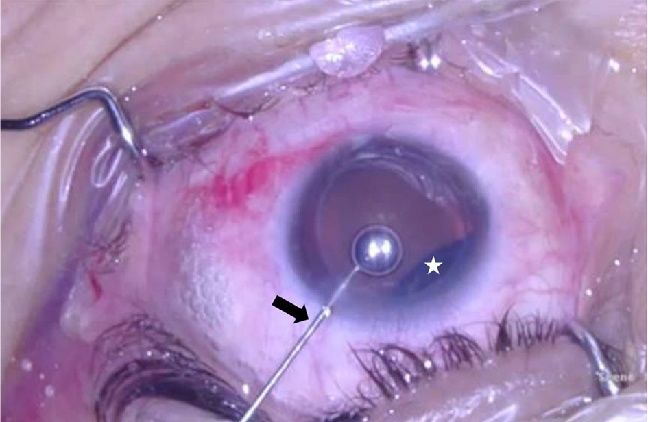 A Rare Case of Anterior Chamber SF6 Gas as a Complication of Pneumatic