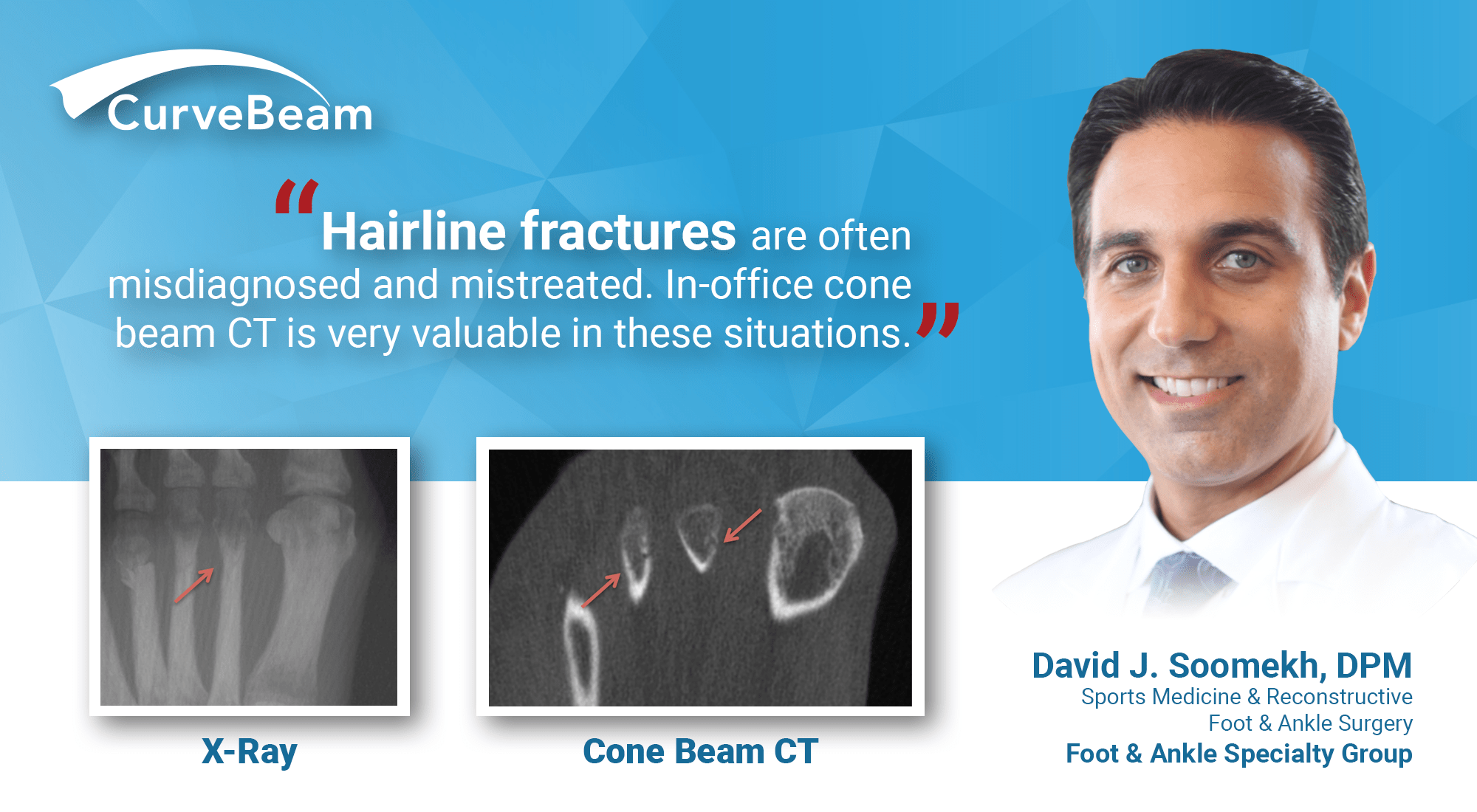 Hairline Fractures Dx w/ InOffice CT Imaging CurveBeam