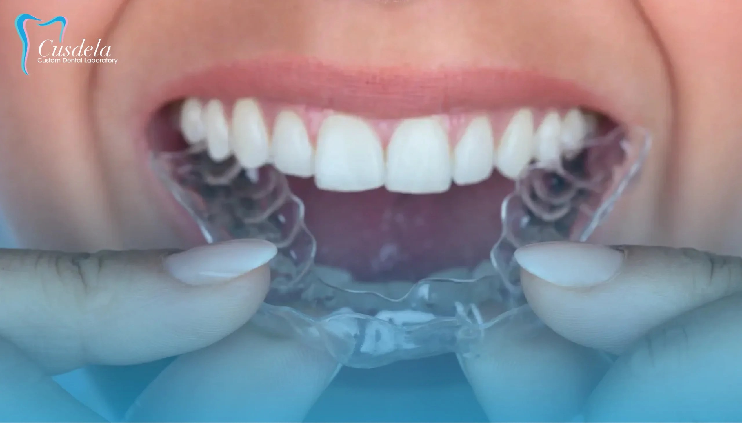 Why do you need to wear retainers? Cusdela Dental Lab