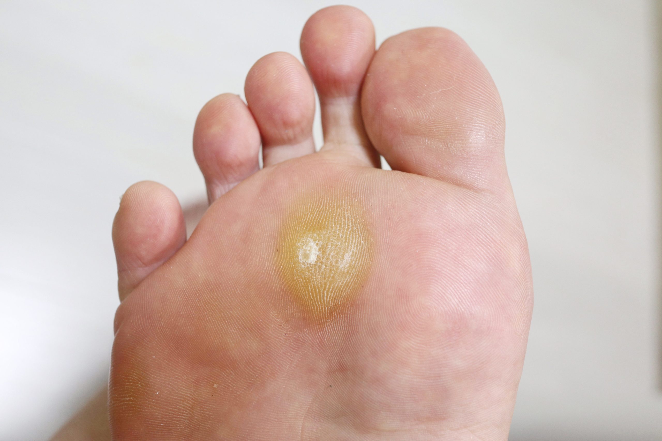 Corns and Callus Cutting Edge Podiatry