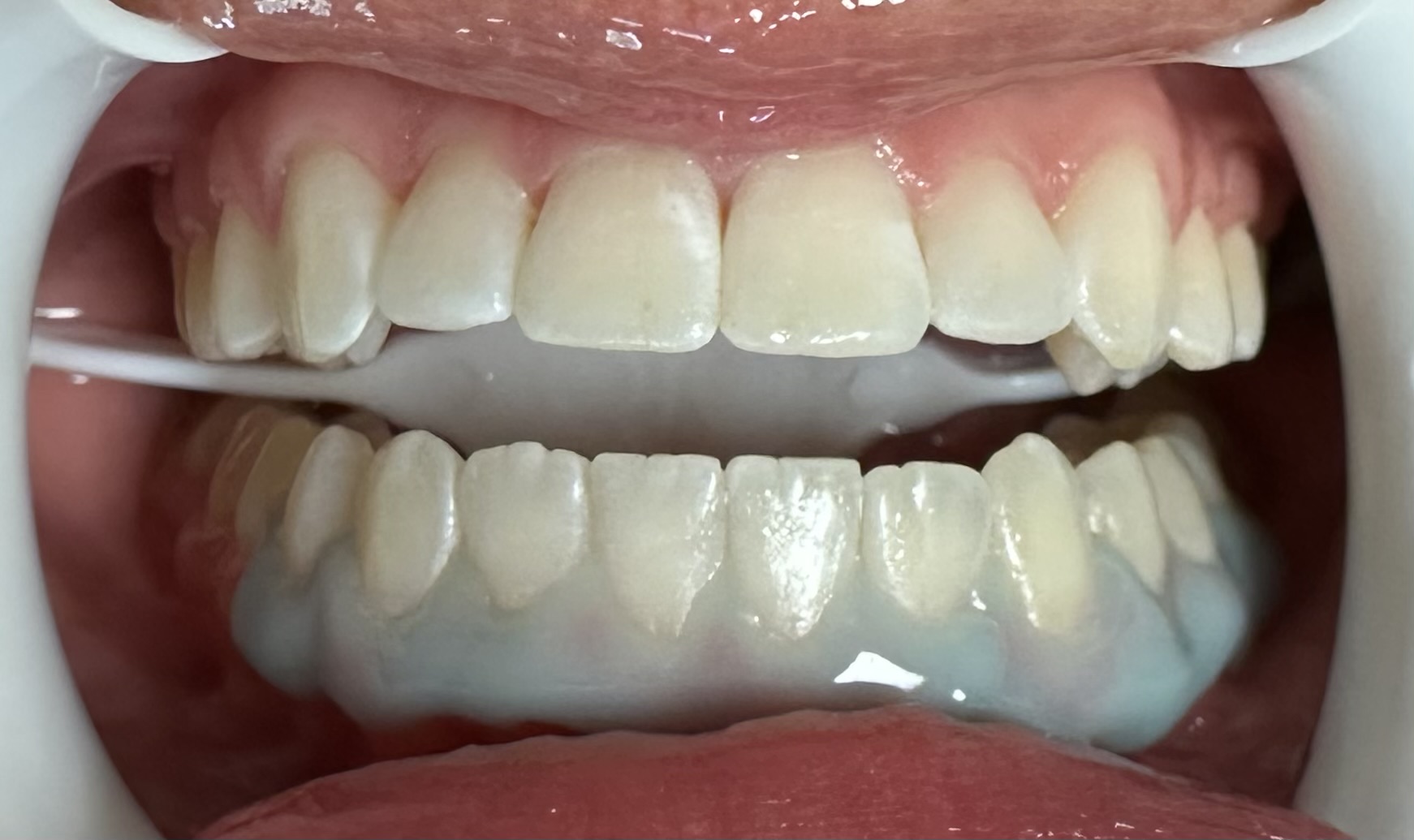 GLO Whitening - Cumberland Valley Dental Care