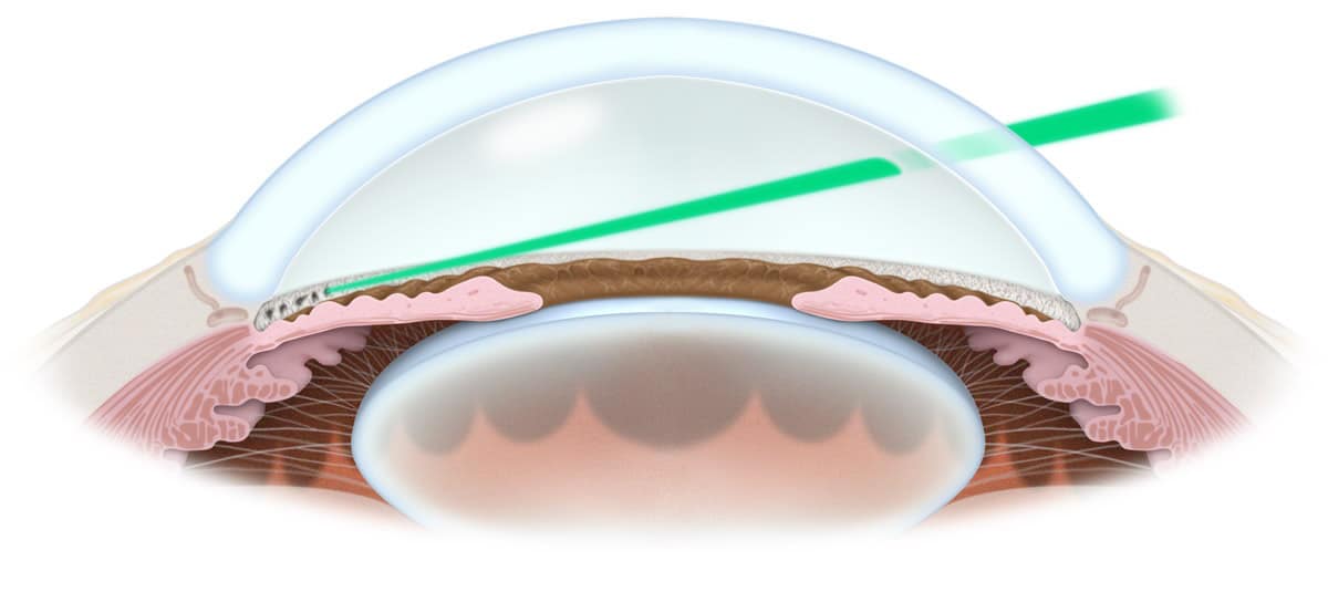 Medical and Laser Treatment Central Valley Eye Medical Group