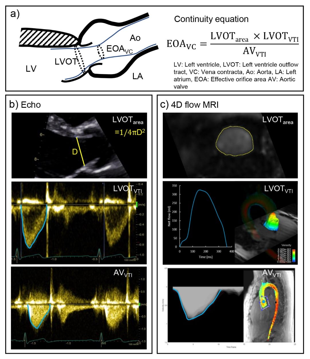 Echocardiography and 4D flow MRI Northwestern Cardiovascular MR