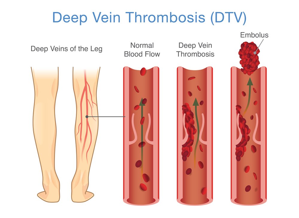 Acute Deep Vein Thrombosis (DVT)