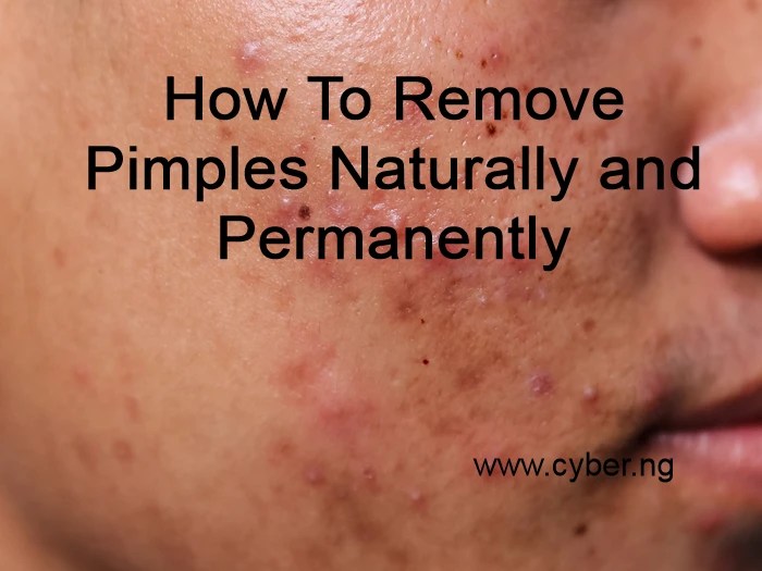 How To Remove Pimples Naturally and Permanently CYBER NG