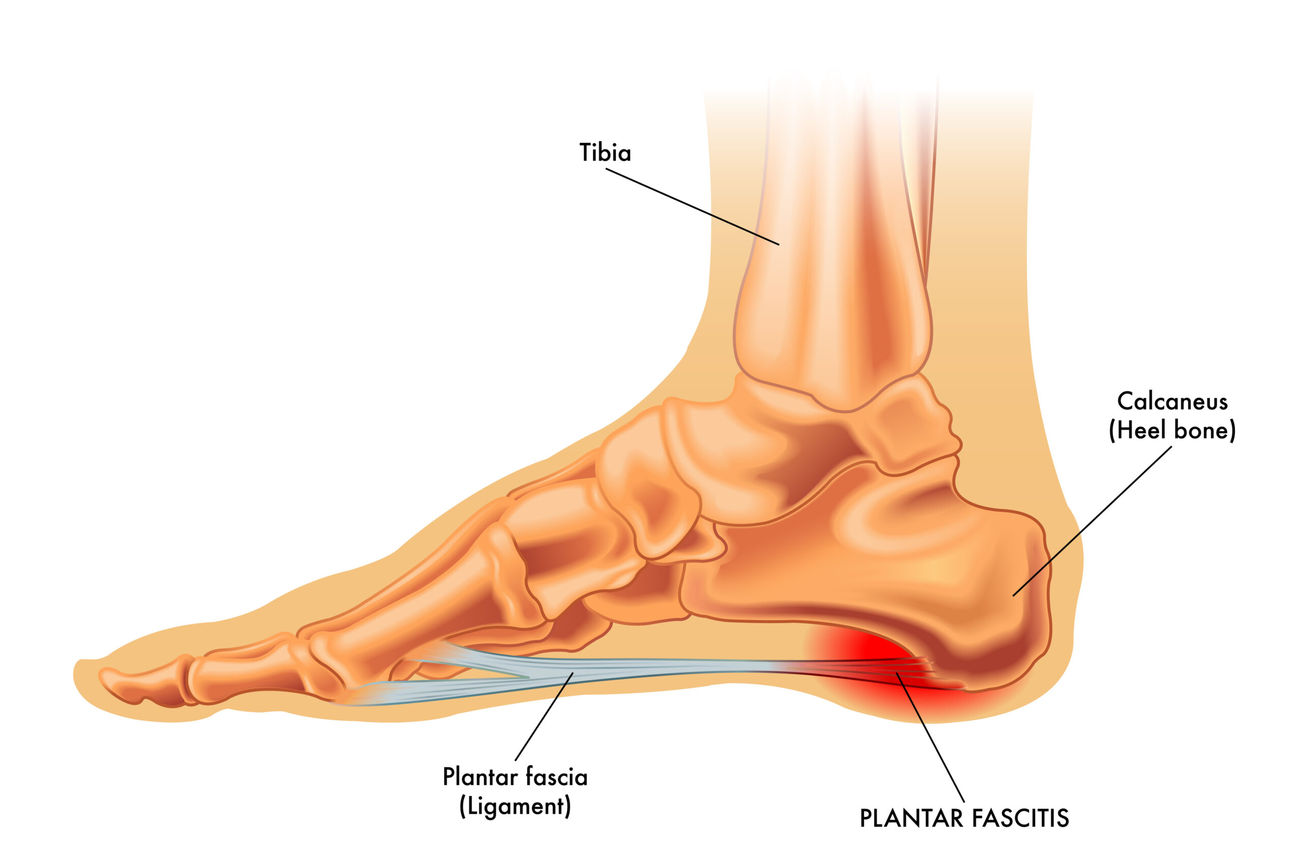 Plantar Fasciitis Definition, Causes, Prevention & Practical