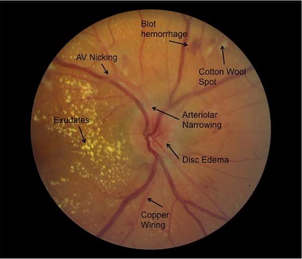 HIGH BLOOD PRESSURE AND IT’S EFFECT ON THE EYES Cypress Eye Centre
