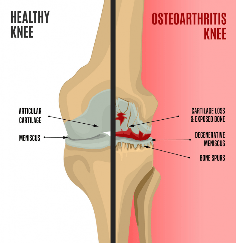 Common Types Of Arthritis That Affect The Knee cyriaxphysio