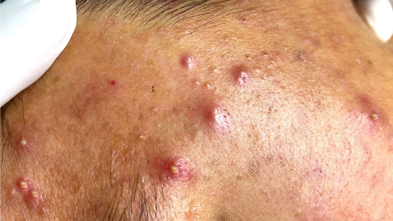 Blackheads Milia Big Cystic Acne Blackheads Extraction Whiteheads