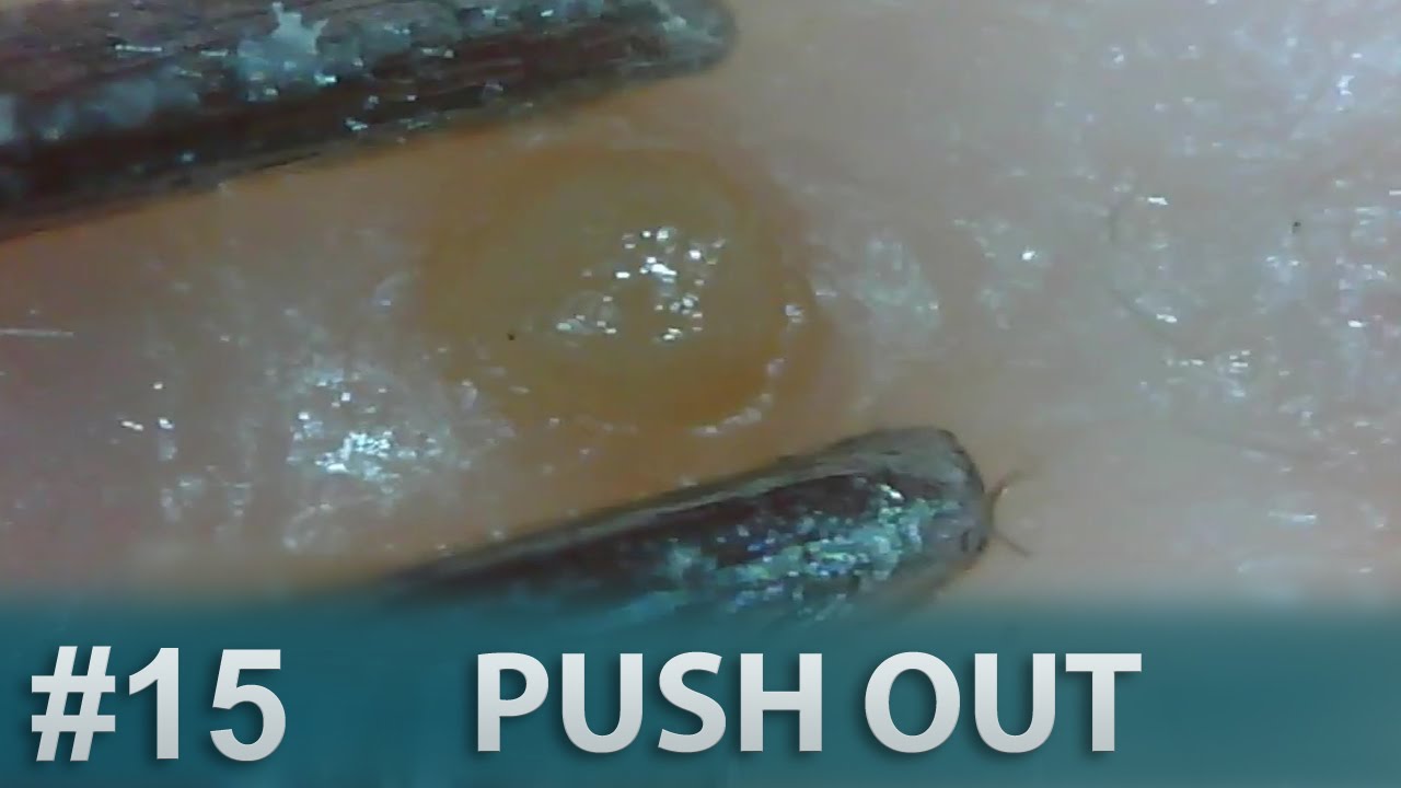 51 Pull Out Blackheads Close up 200X Blackheads Removal Pimple