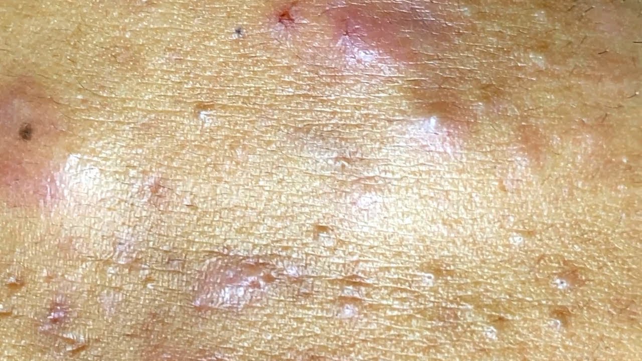 BLACKHEADS EXTRACTIONS on Happy's Upper Lip Pimple Popping Videos