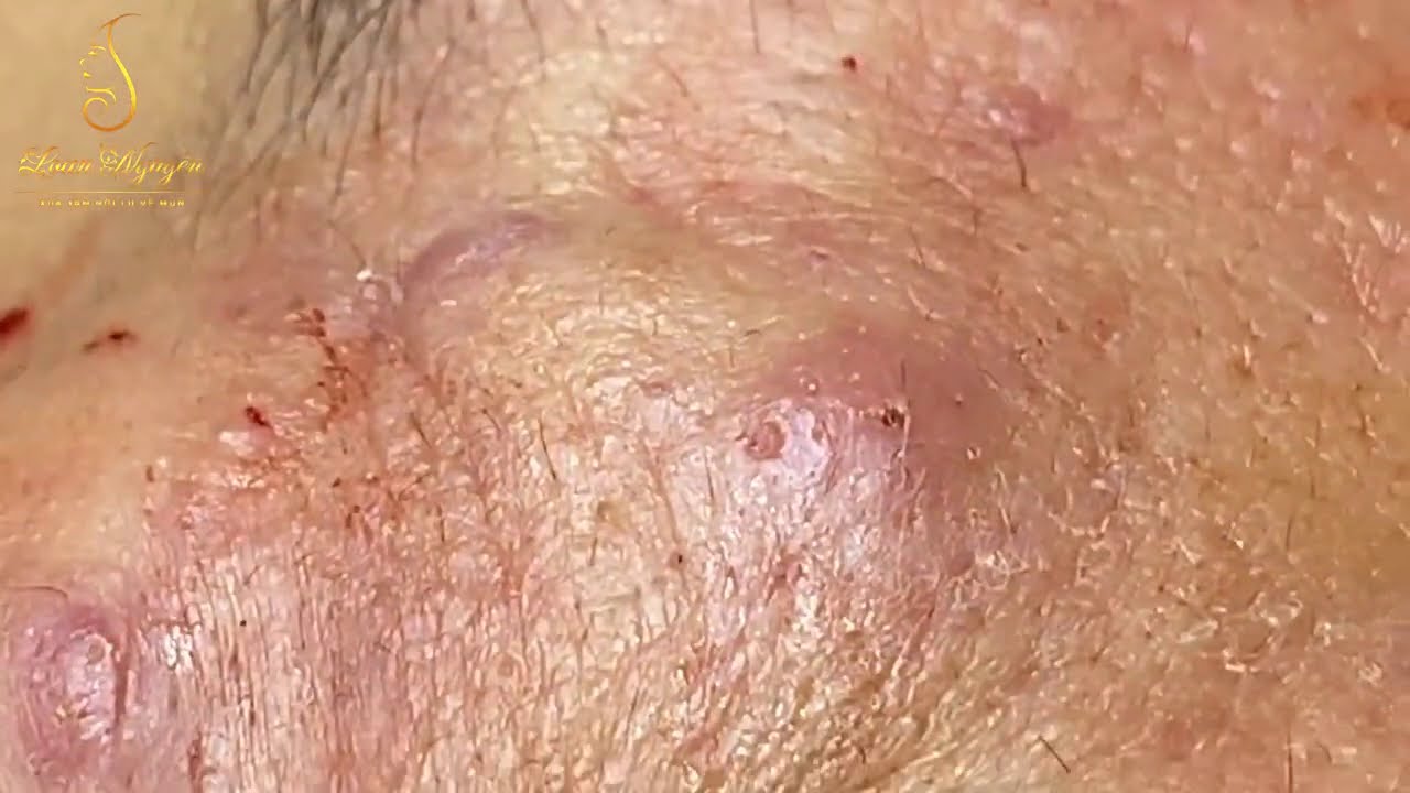 Blackheds and whiteheads extraction (284) Loan Nguyen Pimple