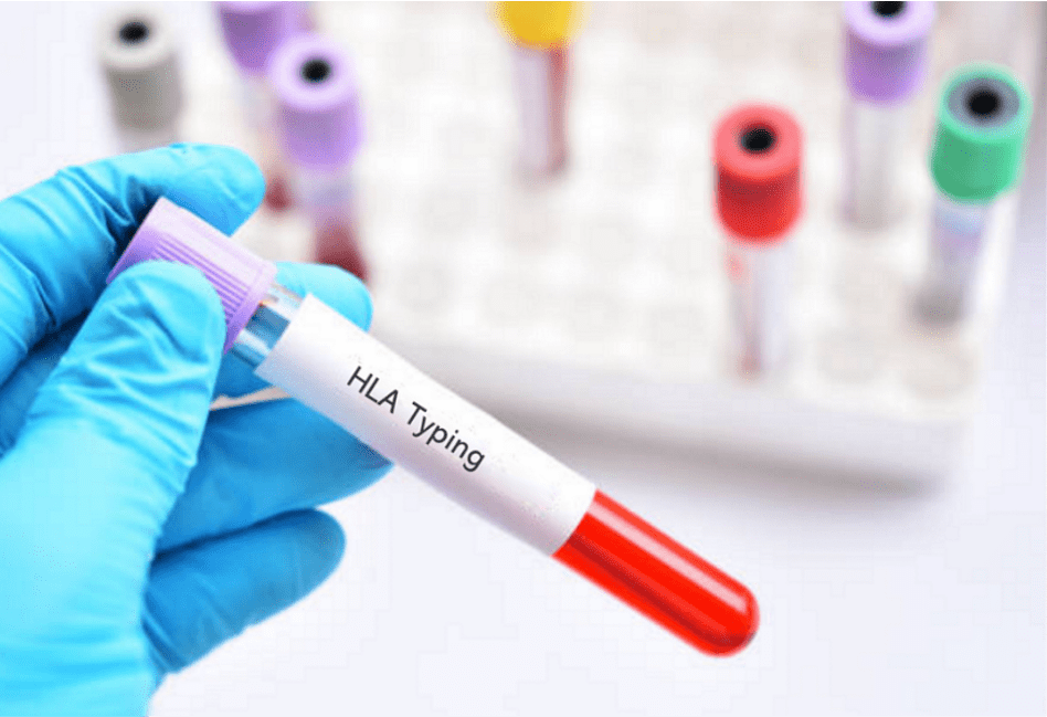 What Is HLA Typing and How Is It Performed? Cytologics