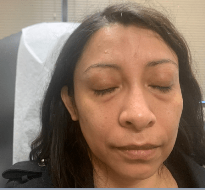 Delayed Complication of “FishOil” Injection Into the Face Associated With COVID19 Exposure