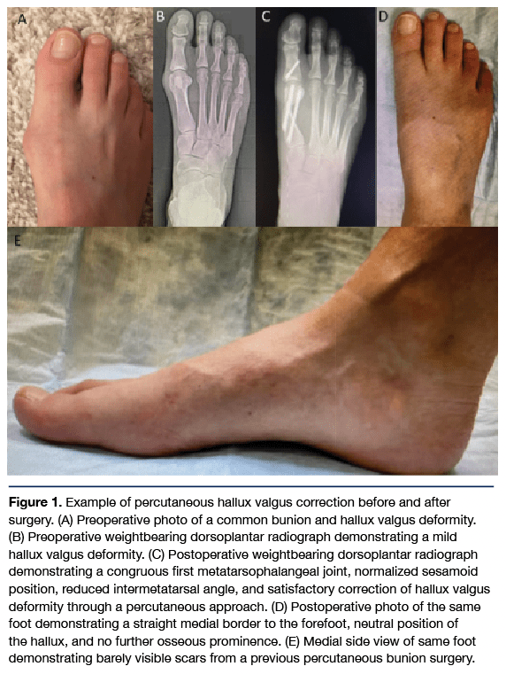 Perioperative Considerations for Minimally Invasive Foot and Ankle Surgery mifoot