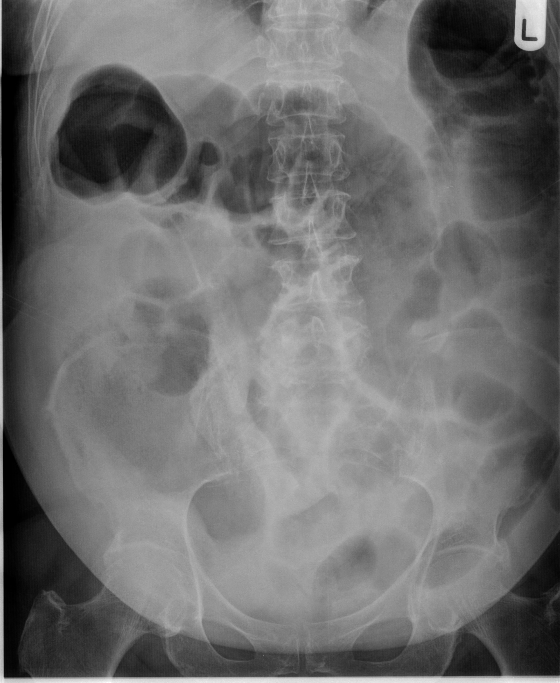 Intestinal Obstruction X Ray