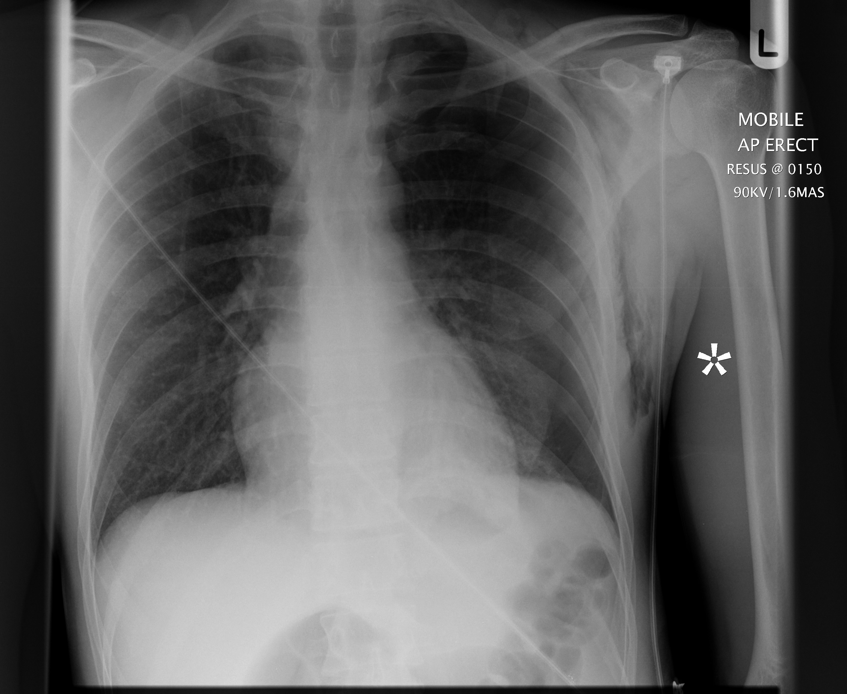 Chest X Ray Findings Pneumothorax Chest X Ray Images