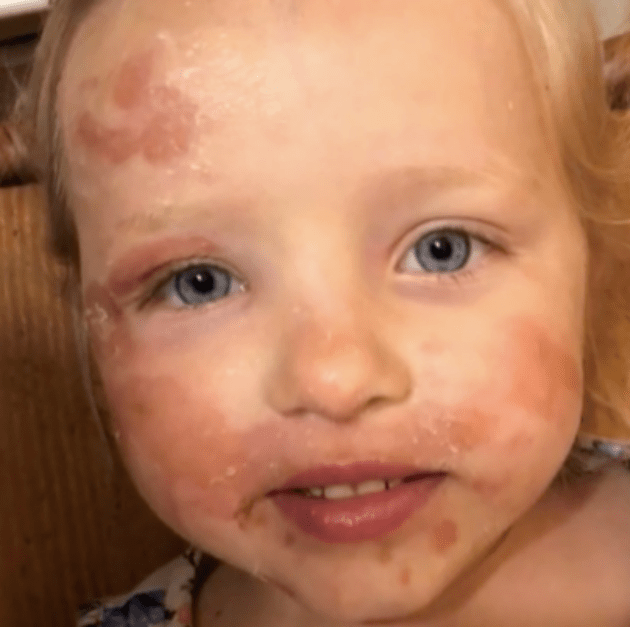 Mom Warns Others After Little Girl’s Skin Blisters From ‘Margarita Burn’