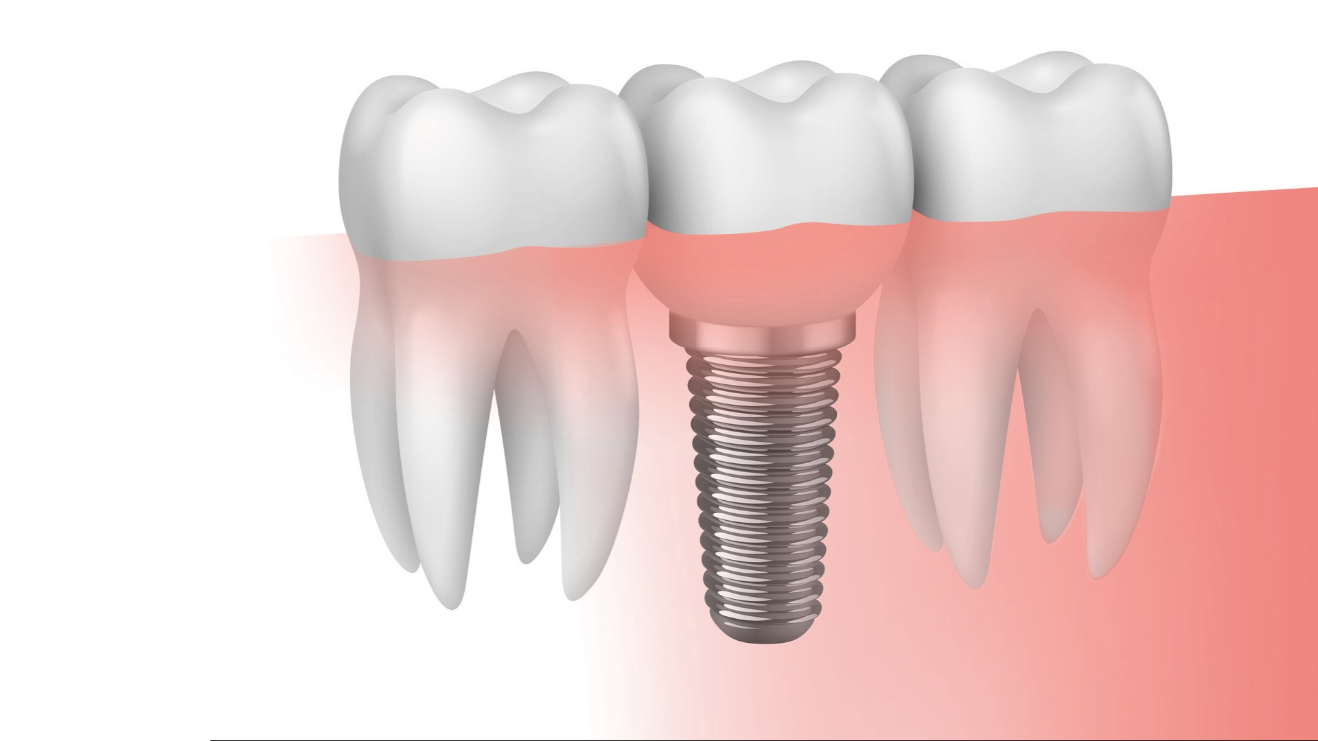 Masterclass odontología Biomateriales en implantologia