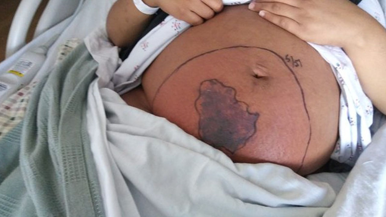 Pregnant woman bitten by brown recluse spider while