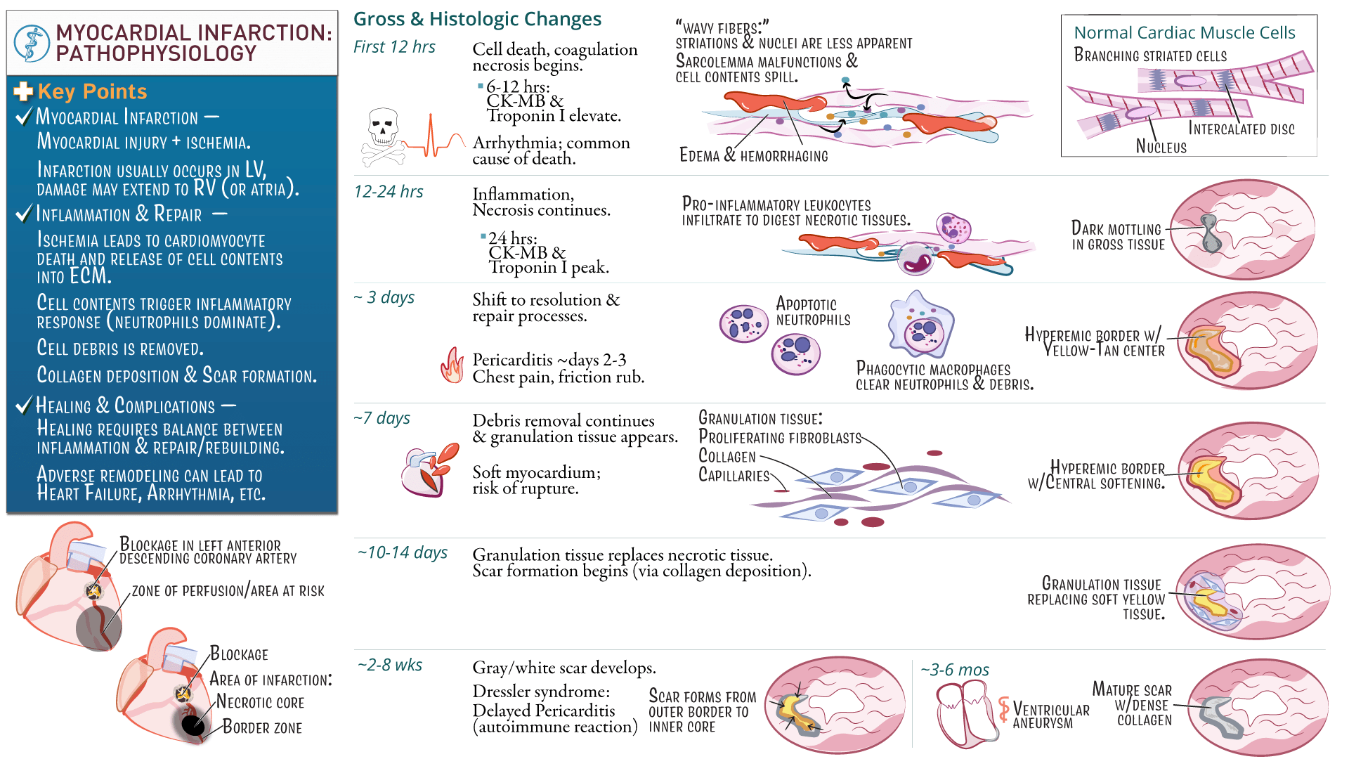 Cardiovascular System: Myocardial Infarctions: Pathophysiology | ditki