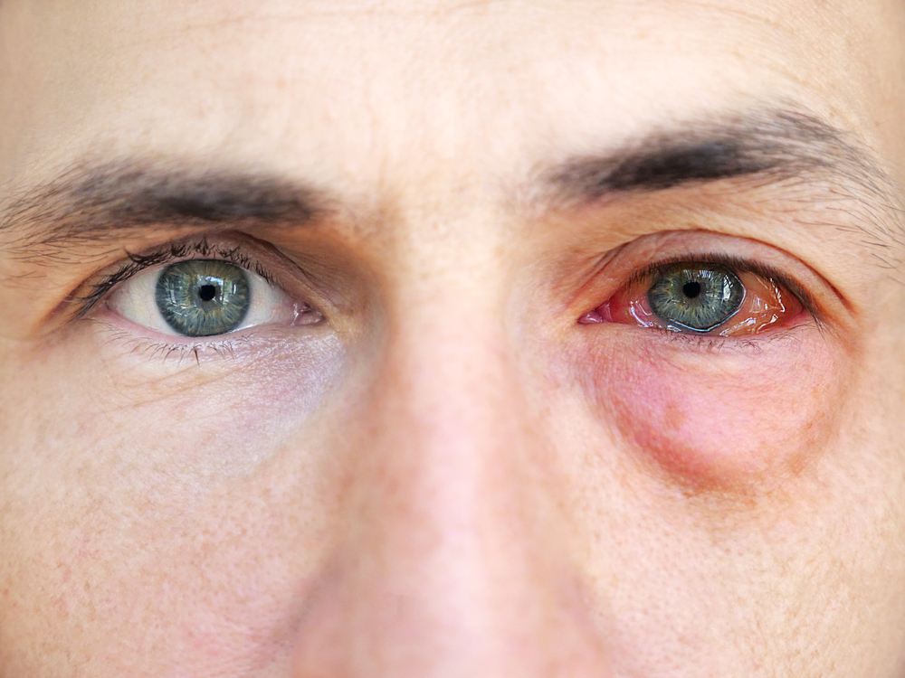 Can Gonorrhea Really Infect Your Eyes? Here’s What You Need to Know