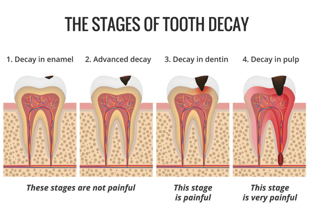 Tooth Decay Treatments in Melbourne 60 Dental Check Up