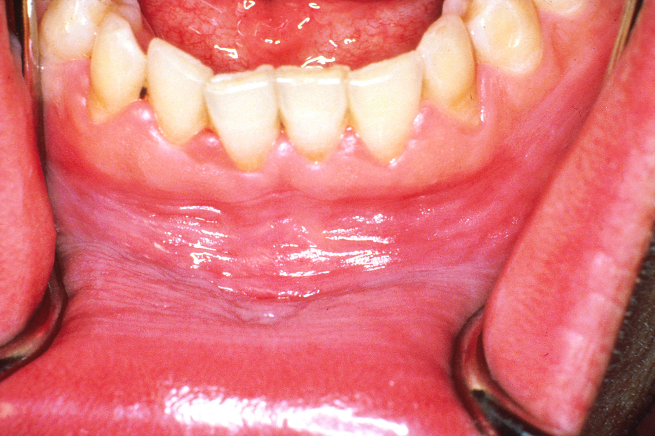 These pictures also illustrate more on the visual appearance of sores, bumps or blister on the palate for your better visual understanding. Mouth Cancer Pictures What Oral Cancer Sores Look Like