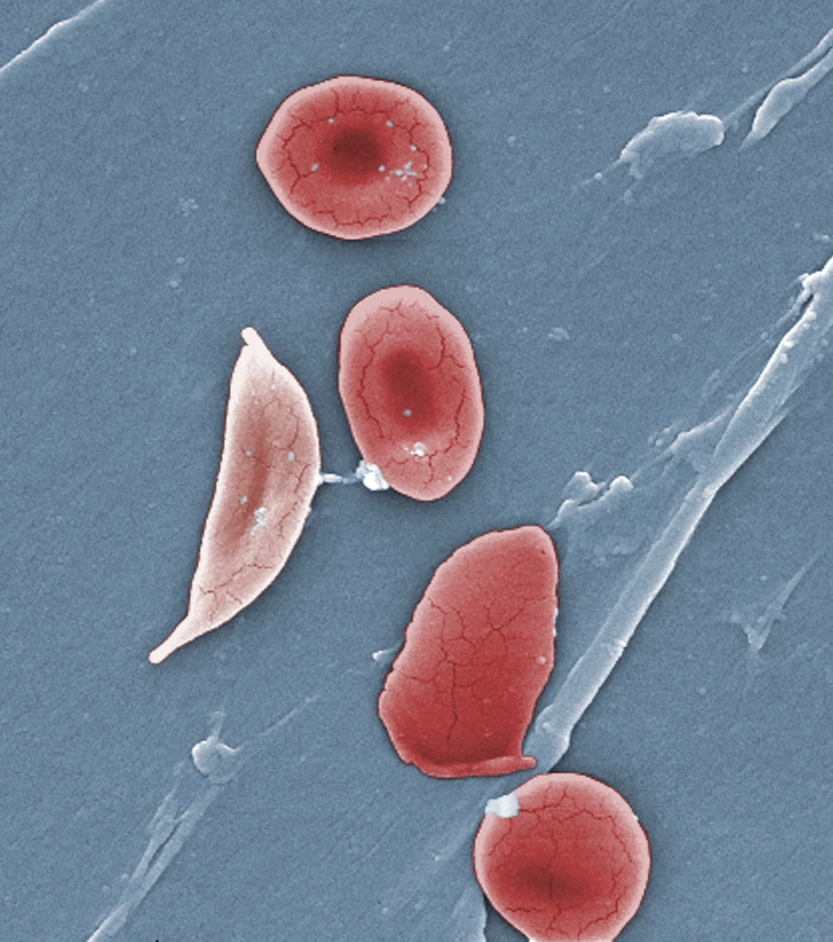 Gene Editing Treatment Shows Promise For Sickle Cell Disease WBUR News