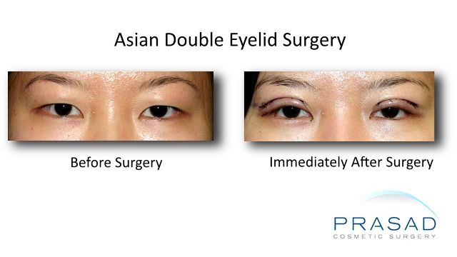Asian Double Eyelid Surgery in New York Amiya Prasad MD