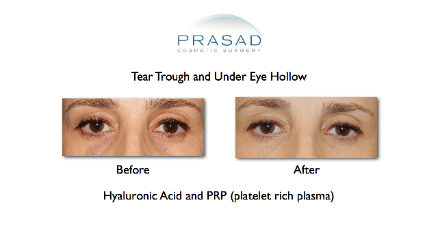 PlateletRich Plasma (PRP) for Tear Troughs and Eye Bags Treatment